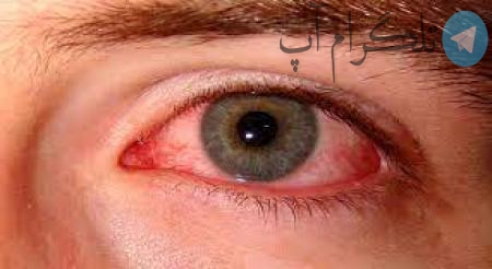 اینفوگرافیک| قرمزی چشم دلیل چه بیماری هایی است؟ – تلگرام آپ